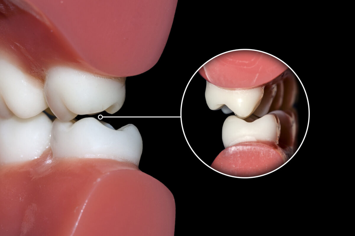 Ti sei sorpreso a digrignare i denti? Perché accade e cosa si può fare a riguardo