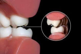 Ti sei sorpreso a digrignare i denti? Ecco perché accade e cosa puoi fare al riguardo