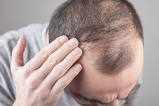 Prodotti anticaduta capelli: i migliori consigliati dai consumatori