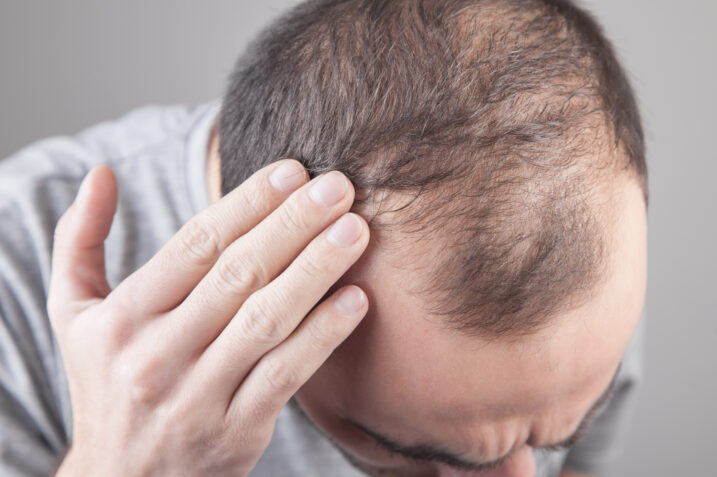 Prodotti anticaduta capelli: i migliori consigliati dai consumatori