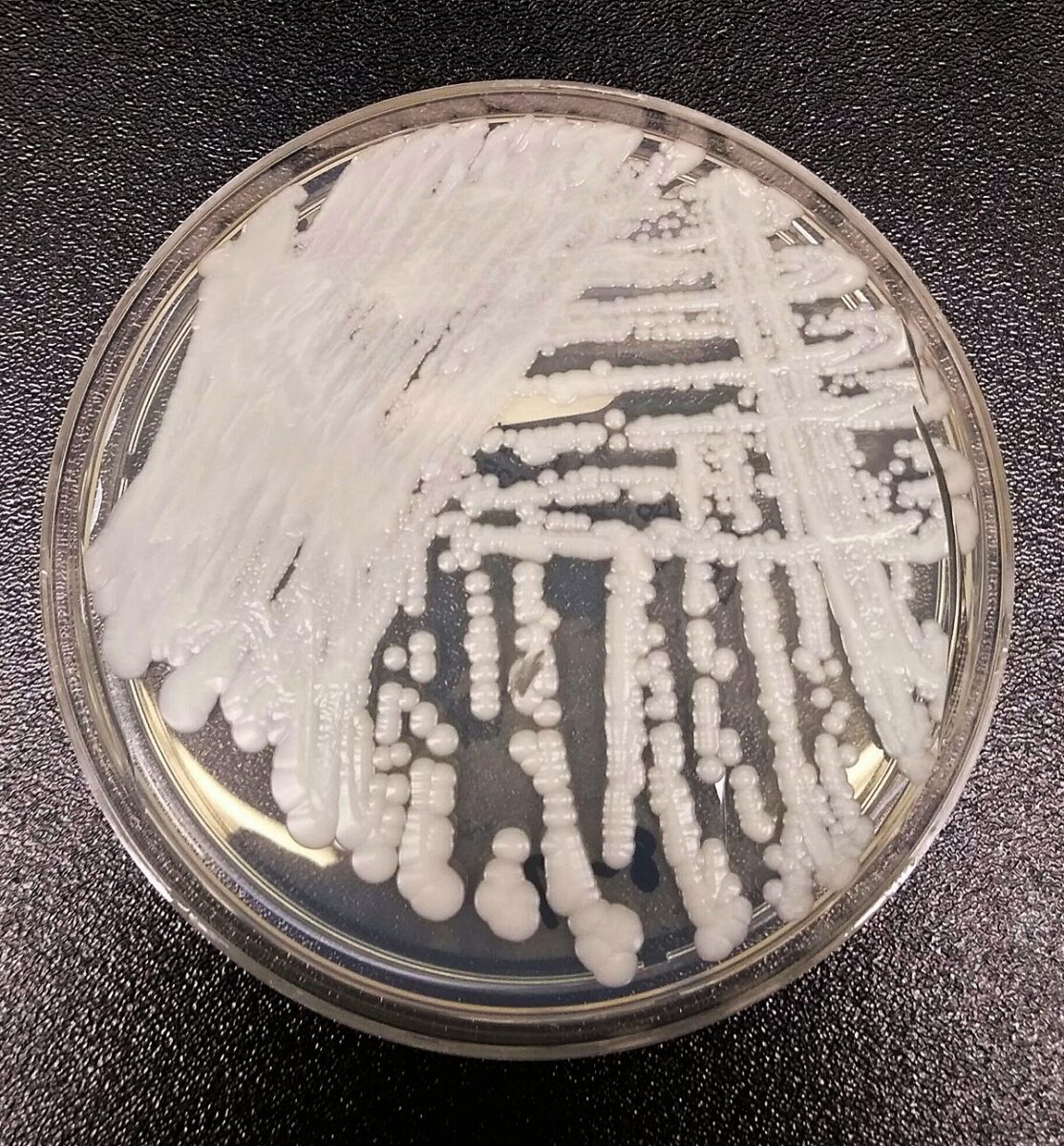 Primo caso italiano di Candida Auris: il fungo resistente ad antimicotici e disinfettanti