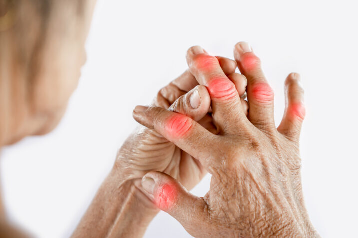 Prevenzione dell'artrite: ecco i consigli degli esperti
